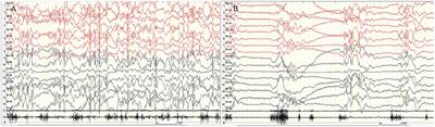 Case Report: A Case of Eyelid Myoclonic Status With Tonic–Clonic Seizure and Literature Review